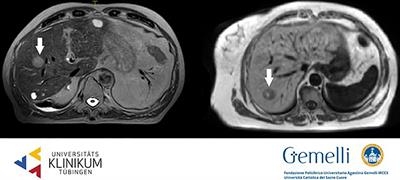 MR-Guided Radiotherapy for Liver Malignancies